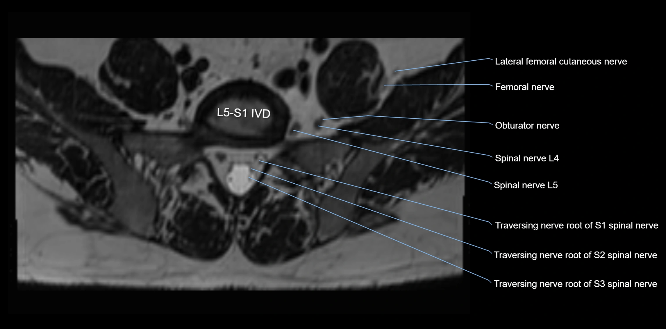 MR lumbosacral plexus axial cross sectional anatomy 3T  radiology  image-img-1008001-00065.webp